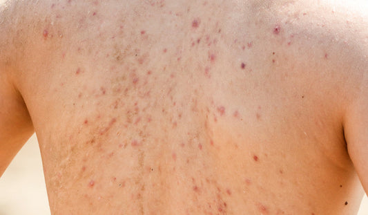 Body Acne: The Triggers & The Solution