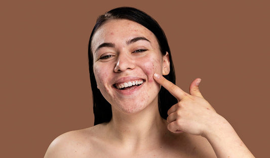 Busting the 'Pop' Culture with Acne Myths and Truths - Neude Skin