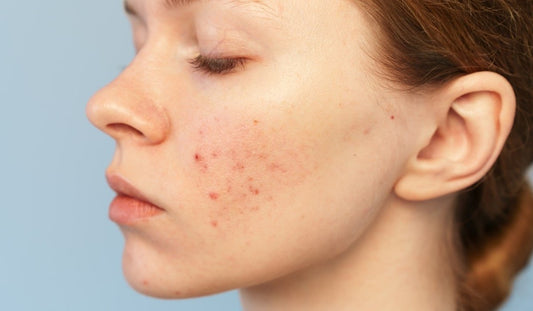 Skin Hungover? Time for a Post-Festive Detox - Neude Skin